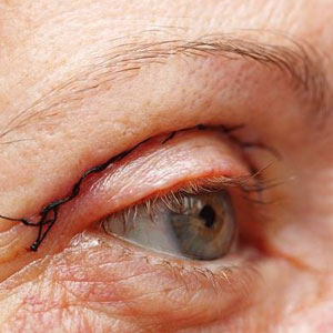 entropion ectropion correction